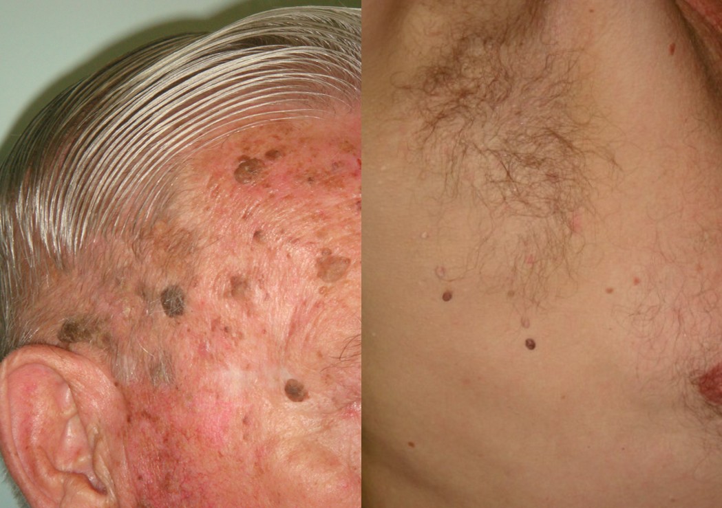 Cosmetic mole removal example, Skin Alert Paradise Point