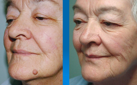 Cosmetic skin tag removal example, Skin Alert Paradise Point