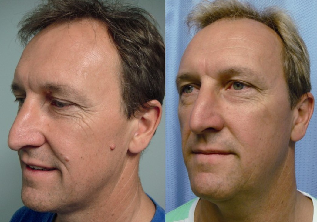 Cosmetic age wart removal example, Skin Alert Paradise Point