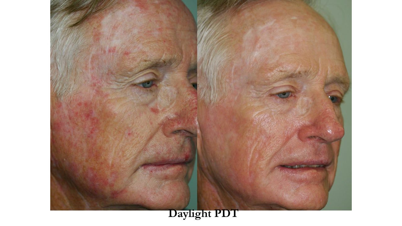 PDT before and after result on a male patient at Skin Alert Paradise Point