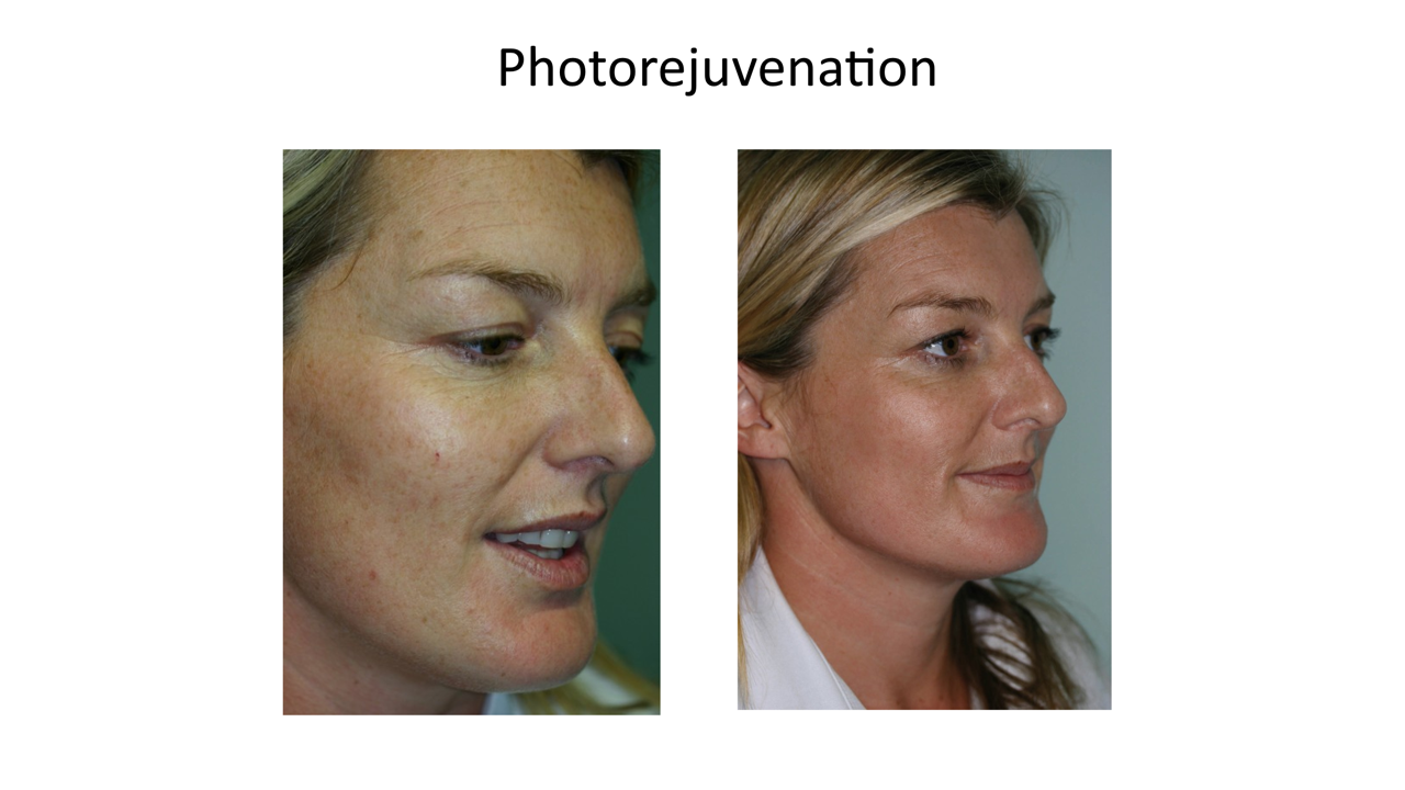 PDT before and after result on a younger female patient at Skin Alert Paradise Point